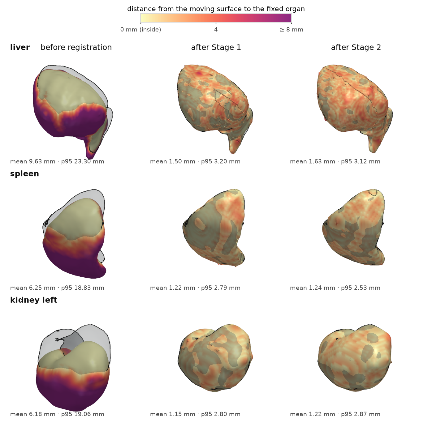 Organ surfaces coloured by distance to the fixed organ, before registration, after Stage 1 and after Stage 2